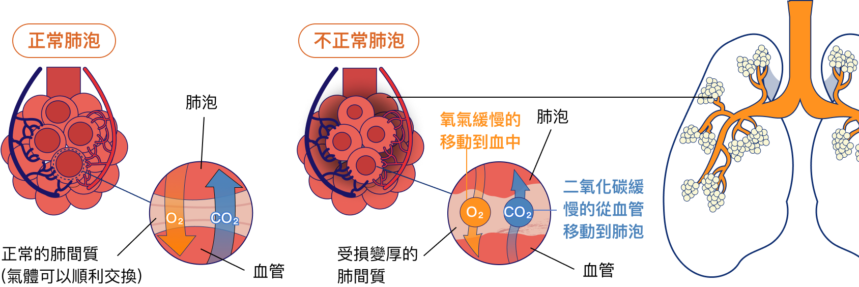 自體免疫疾病發生肺部疾病